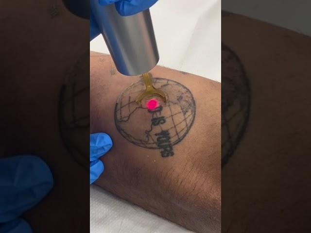 Would you get rid of this tattoo? #tattooremoval #lasertattooremoval #tattooremover #laser #tattoo