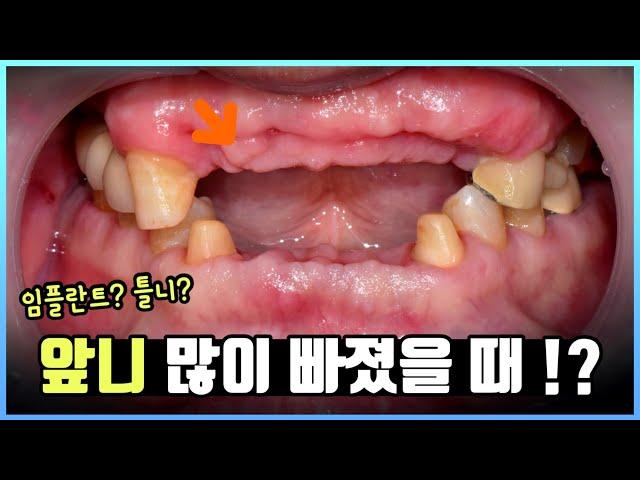 앞니 임플란트, 앞니 브릿지? 앞니 많이 빠졌을 때 치료는? 앞니 치료 전후 사진