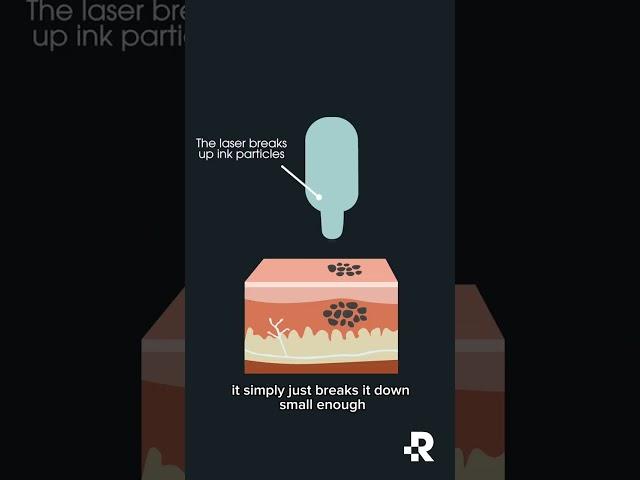 Laser Tattoo Removal Explained