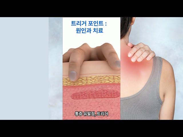 트리거 포인트의 비밀: 진단과 치료의 열쇠 Trigger Points Unveiled: Diagnosis & Treatment