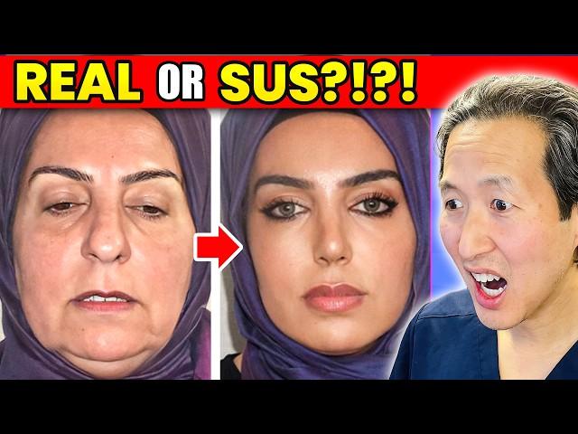 INSANE Turkish Cosmetic Surgery Results! Real or SUS?