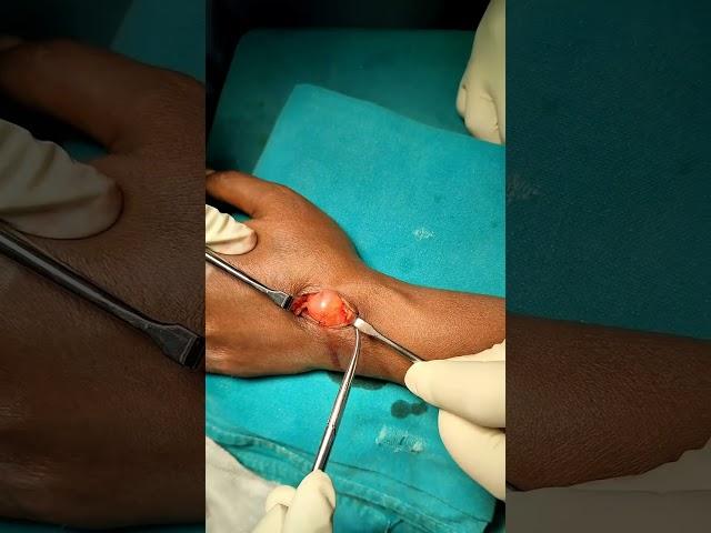 Ganglion cyst removal Surgery in Hyderabad | Dr. Arun Dev, Best Orthopaedic  Surgeon, Kompally