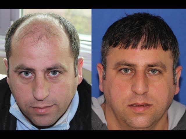 8300 Grafts  | FUE Hair Transplant Before and After