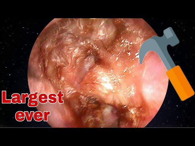 LARGEST Ear Wax Removal, 20 years ear surgery | Doctor Anh