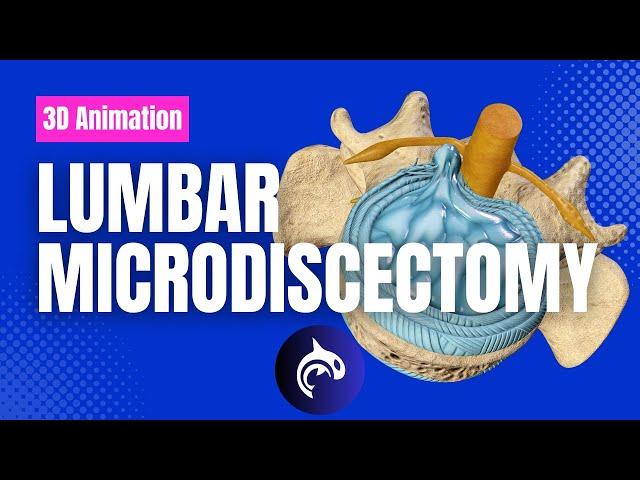 Lumbar Microdiscectomy - 3D Animation