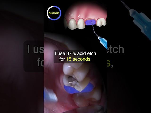 Cementing a Fully-Sintered Zirconia Crown | Ep 5 #dentalshorts