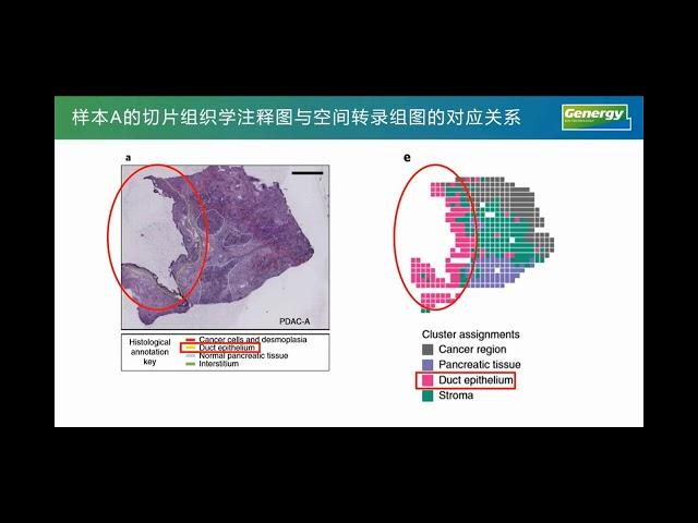 【陈巍学基因】解读用空间转录组和10x单细胞测序分析胰腺导管腺癌的论文