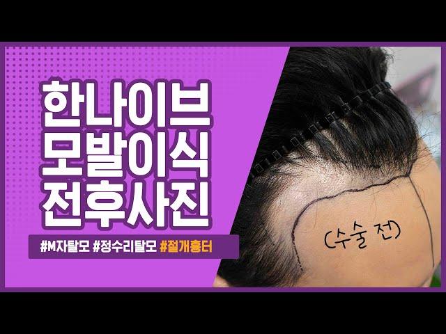 탈모인들을 위한 생착률 높은 #모발이식운동! I 한나이브모발센터