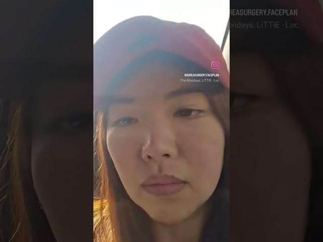 [얼굴기획] 코성형 구축.. 코수술 위험성