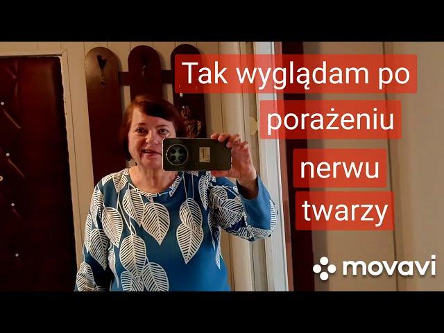 @Mariazaprasza Jak wyglądam po paraliżu nerwu twarzy? Rehabilitacja.Dalszy ciąg.Zapraszam