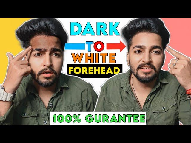 Dark Forehead to White Forehead 100% Gurantee | Sahil Nagpal