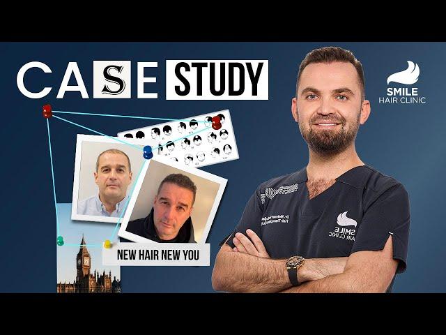 Case Study: 4350 Grafts Hair Transplant | 9-Month Transformation | Smile Hair Clinic