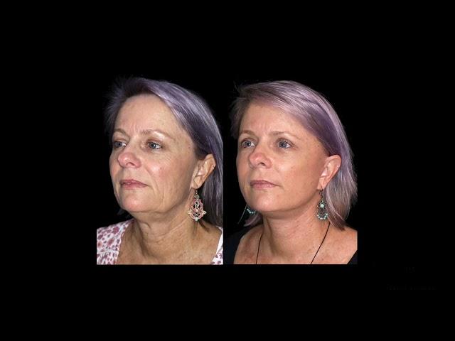Facelift surgery in Brisbane with Dr David Sharp