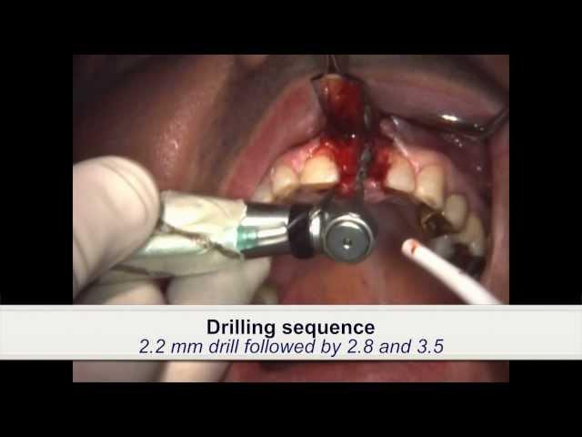 Dental Implant Placement in patient treated with iv bisphosphonates