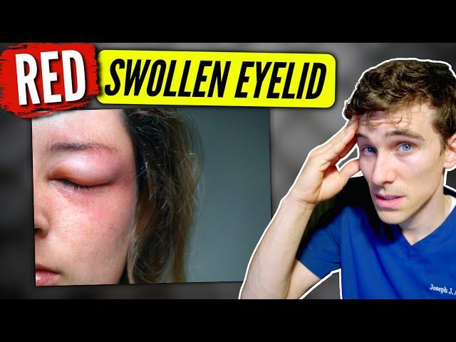 Swollen Eyelid: (causes & solutions) - Eye Doctor Explains