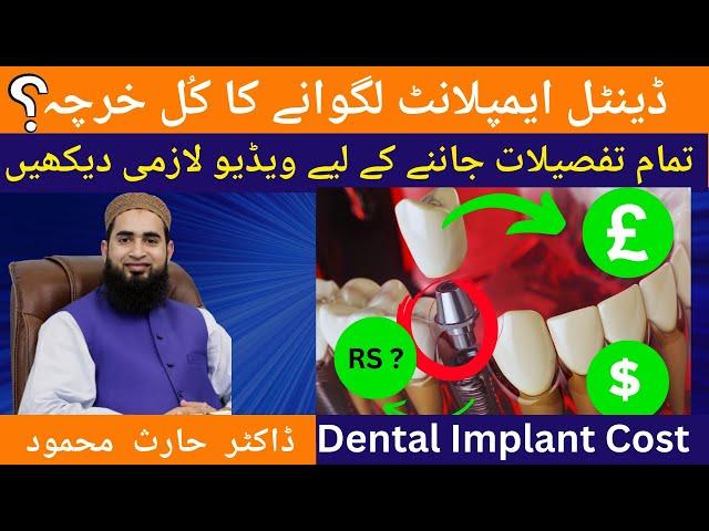 Dental Implant Cost in Pakistan | ڈینٹل ایمپلانٹ لگوانے کا کُل خرچہ | All you need to know