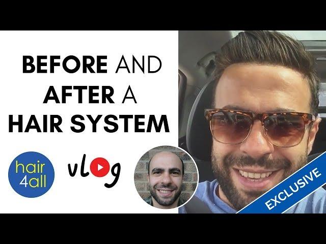 Before & After a Non-Surgical Hair Replacement System for Men