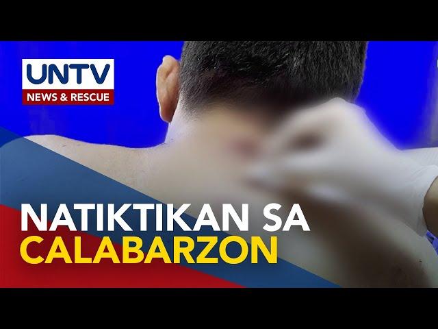 Apat na bagong kaso ng mpox, naitala sa Calabarzon – DOH