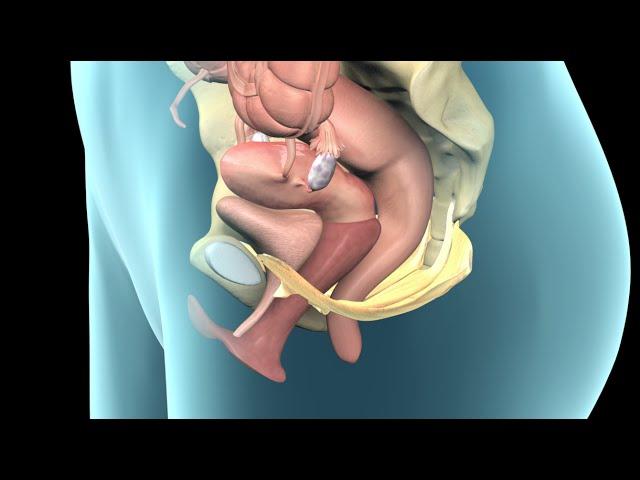 Pelvic Prolapse | Nucleus Health