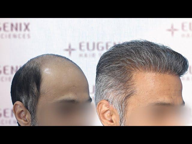 Hair Transplant Result | DHT /FUE | Before & After