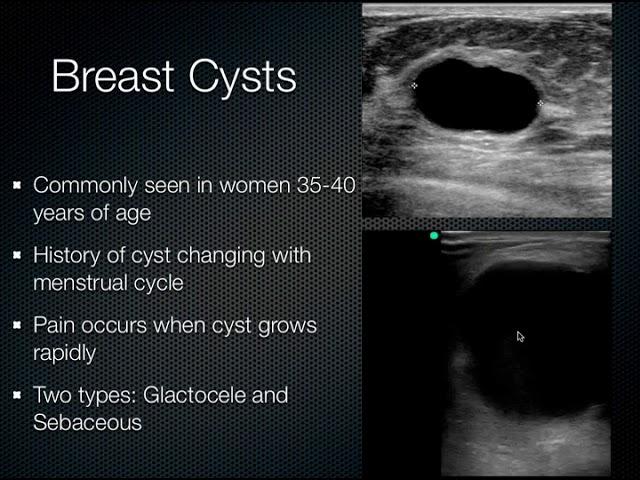 Breast Ultrasound