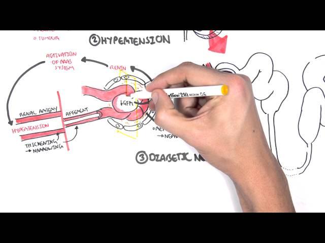 Chronic Kidney Disease (CKD)  Pathophysiology