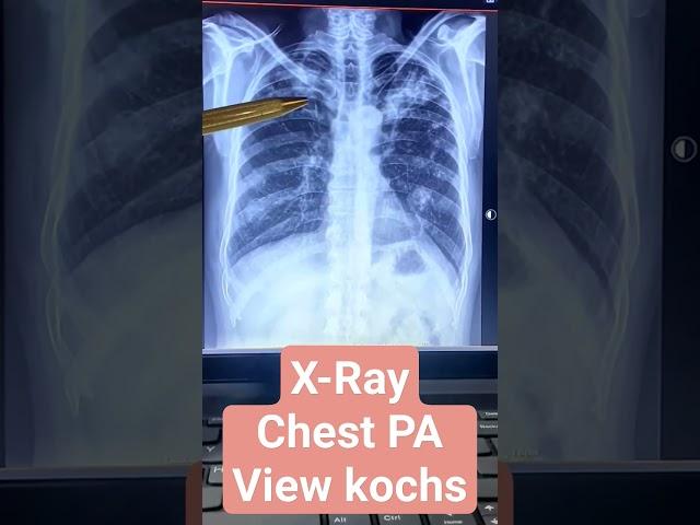 Learn the art of mastering chest x-ray diagnosis with this comprehensive guide! Chest x-rays