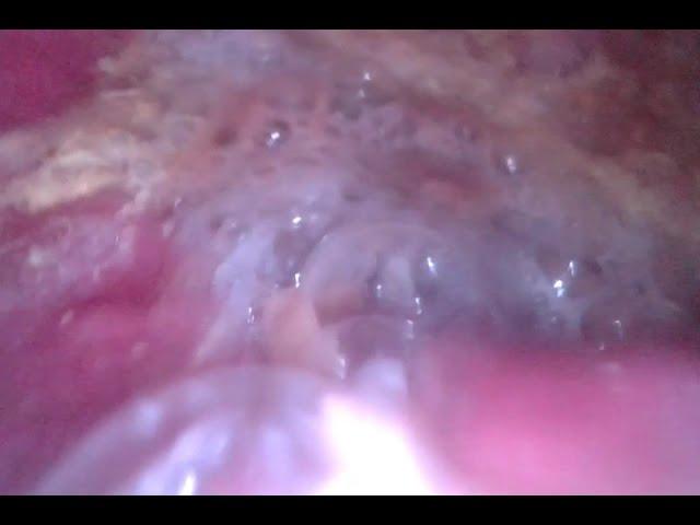 STOMACH CAM second try