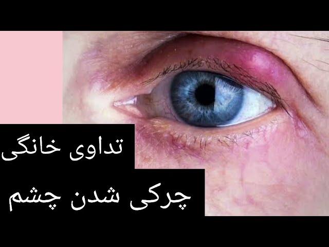 تداوی خانگی چشم دردی، چشم چرکی، گل مژه