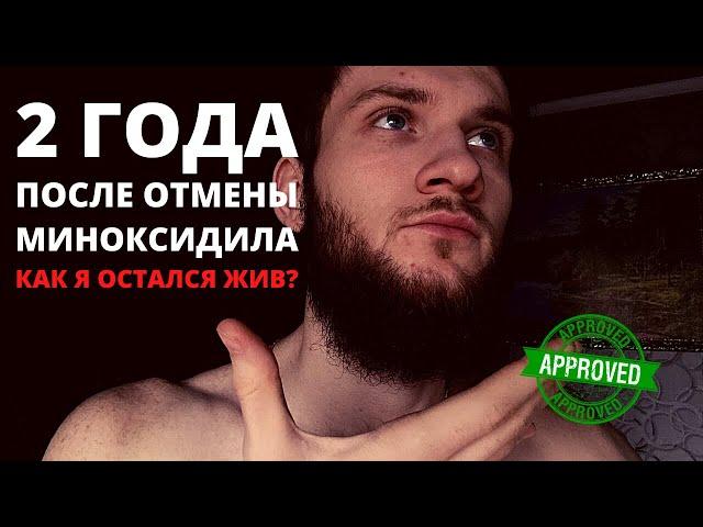 Миноксидил зло? Реально ли вырастить густую бороду? 2 года после отмены миноксидила. История успеха