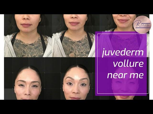 Juvederm near me Wisconsin