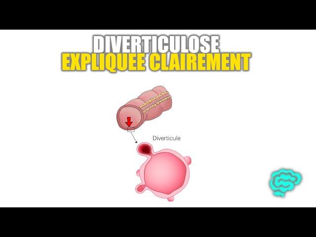  La Diverticulose Expliquée Très Clairement par Dr Astuce