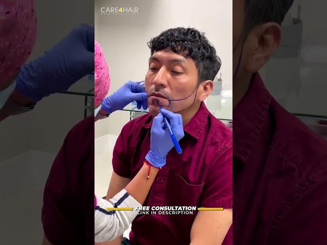 Beard Transplant: This is the procedure  | Care4Hair