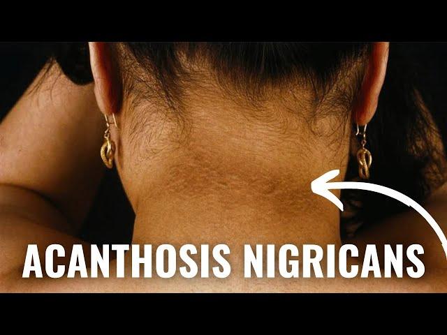 How To Get Rid of Acanthosis Nigricans - Dark Armpits, Groin and Neck