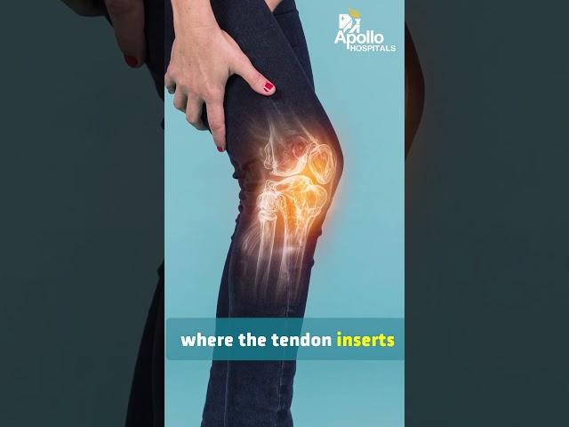 Knee & Ankle Pain in Kids: Apophysitis Explained | Dr. Raviteja Rudraraju | Apollo Hospitals
