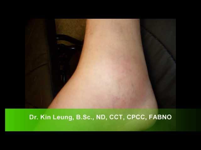 Dr Kin Leung Naturopathic Case Review Patient Gout Noticeable swelling Right ankle Inflamed