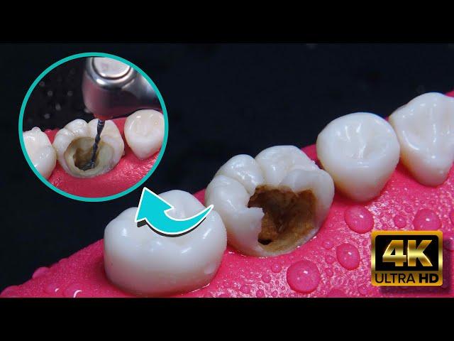 AMAZING reconstruction of tooth damaged by caries: Endodontics