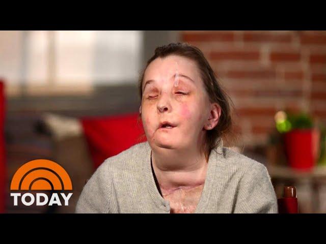 Woman Who Received Face Transplant Meets Donor’s Family | TODAY