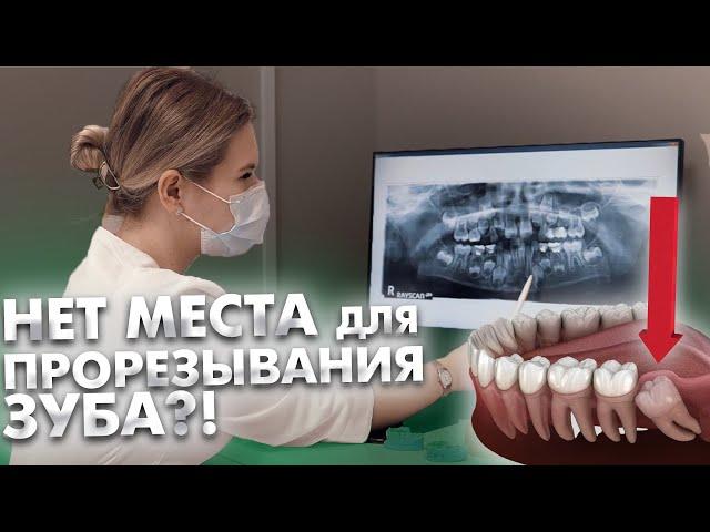 Что делать, если у ребенка дефицит места в зубном ряду для прорезывания постоянных зубов?