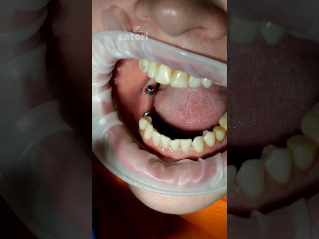 Crowns for dental implants