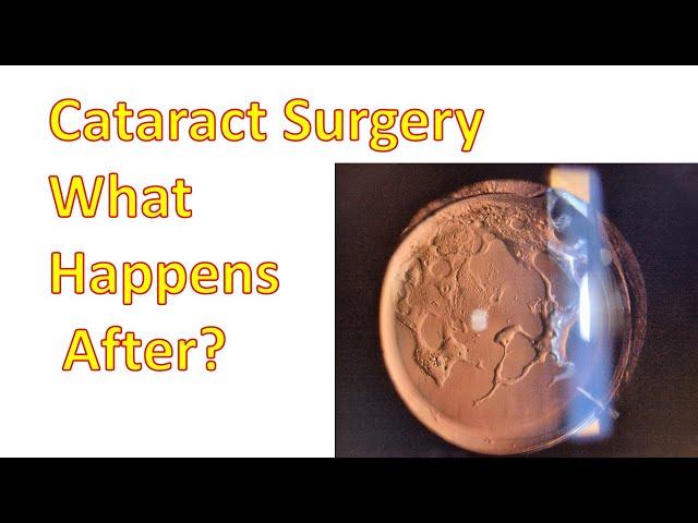 Cataract Surgeries--What Happens Post Operation? (3/4)(4K)