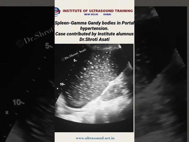 #GamnaGandy #spleen #portalhypertension #ultrasound #drrandhawainstitute #pocus