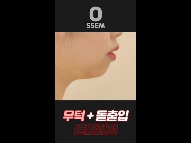 #Shorts 30초 몰아보기 : 무턱+돌출입 교정 전후