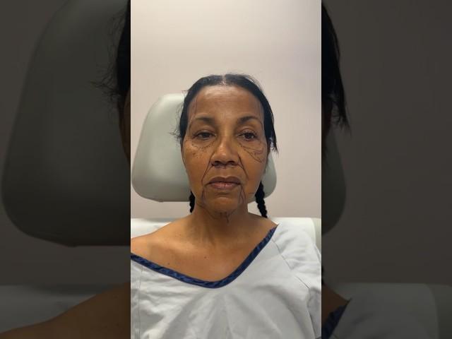 Amazing Facelift Transformation on 62 Year Old Woman!