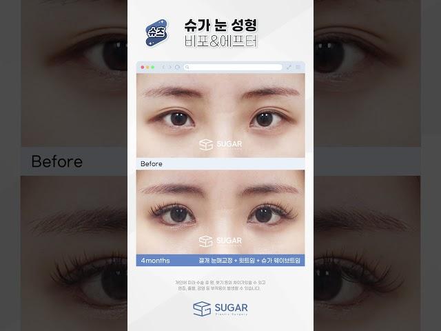 화려한 웨이브트임 #성형외과 #슈가성형외과 #신논현성형외과