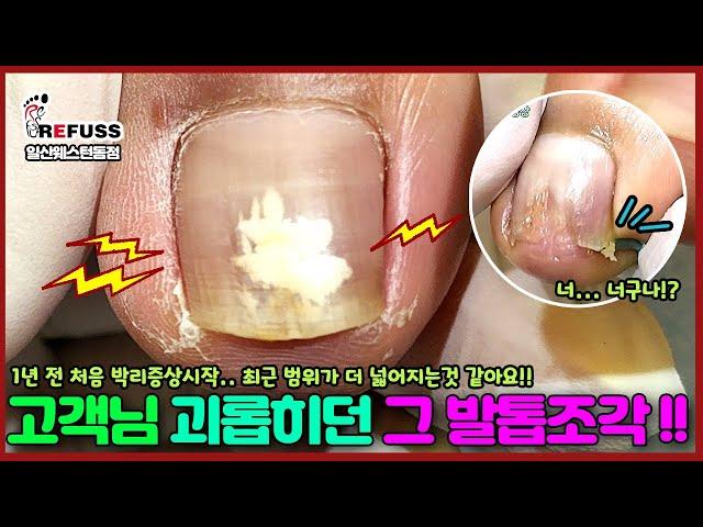 고객님을 끝없이 괴롭히던 그 발톱조각!! 박리증상이 점점 심해져서 찾아오셨어요  #레푸스 #레푸스일산 #발톱 #파고드는발톱 #ingrown_toenail #toenails