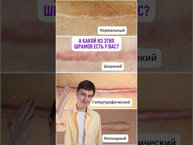 А какой шрам есть у вас?