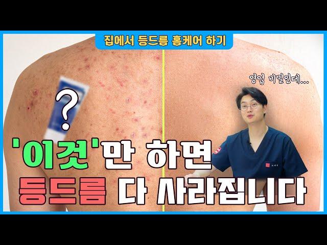 홈케어로 등드름 완벽하게 없애기