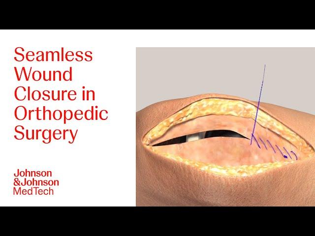 Effective Wound Closure Techniques in Orthopedic Surgeries Using DERMABOND | J&J MedTech