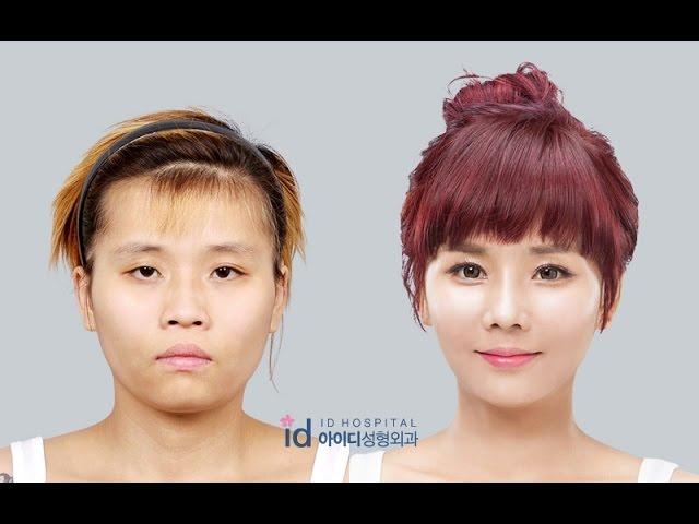 [ID Hospital Review] Korea plastic surgery before and after, Let me in Season 4 Eng Sub